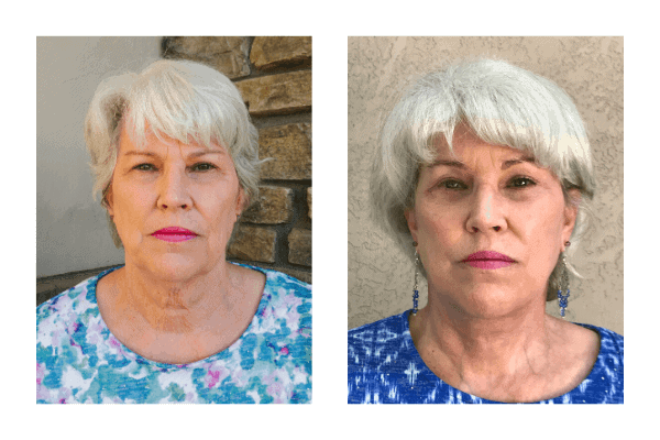 facelift before and after