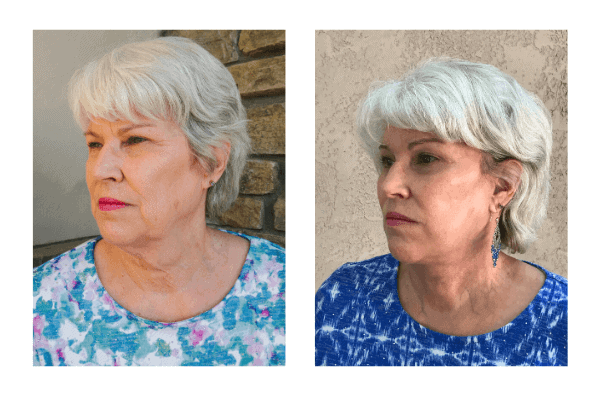 facelift before and after