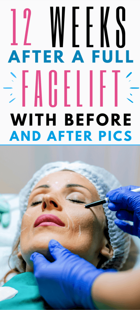 facelift before and after