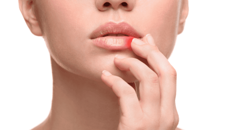 A Surprisingly Easy Way To Get Rid of Cold Sores & Lupus Lip Sores