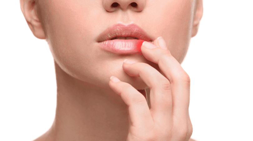 how to get rid of a cold sore